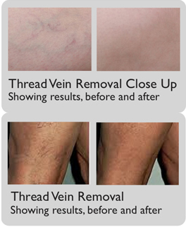 thread-vein