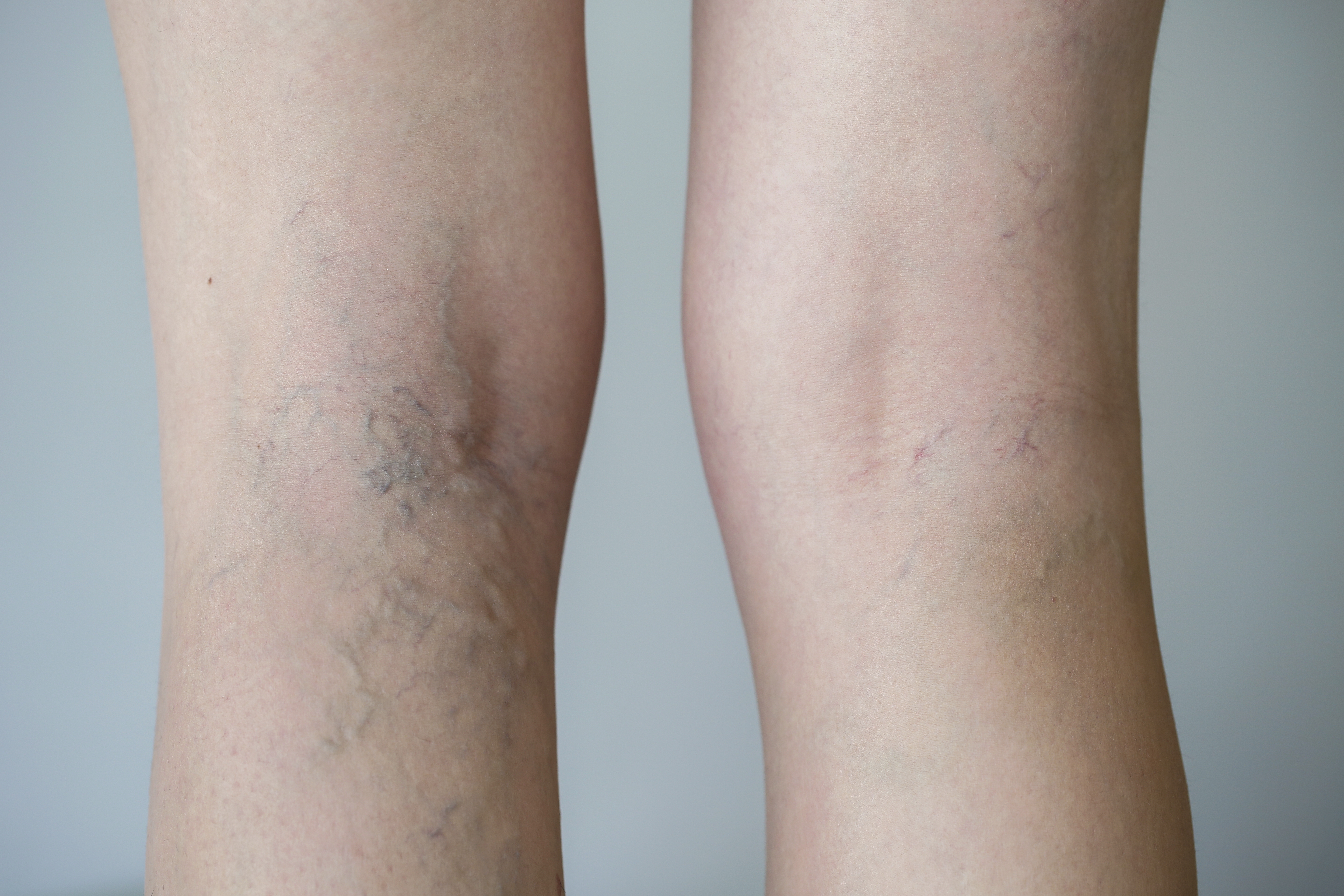 Spider Veins -iStock_000058378654_XXXLarge